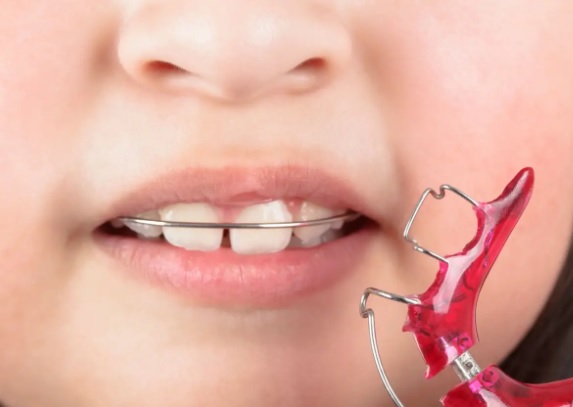 Czym najlepiej myć ruchomy aparat ortodontyczny?