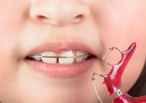 Czym najlepiej myć ruchomy aparat ortodontyczny?